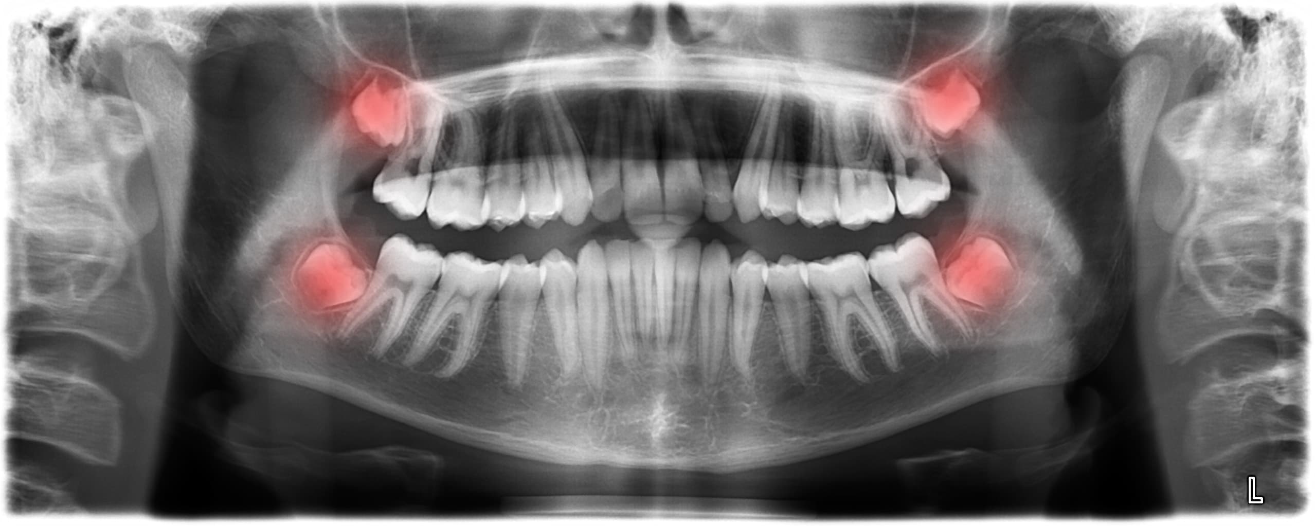 Radiographie panoramique avec les quatre dents de sagesse incluses surlignées