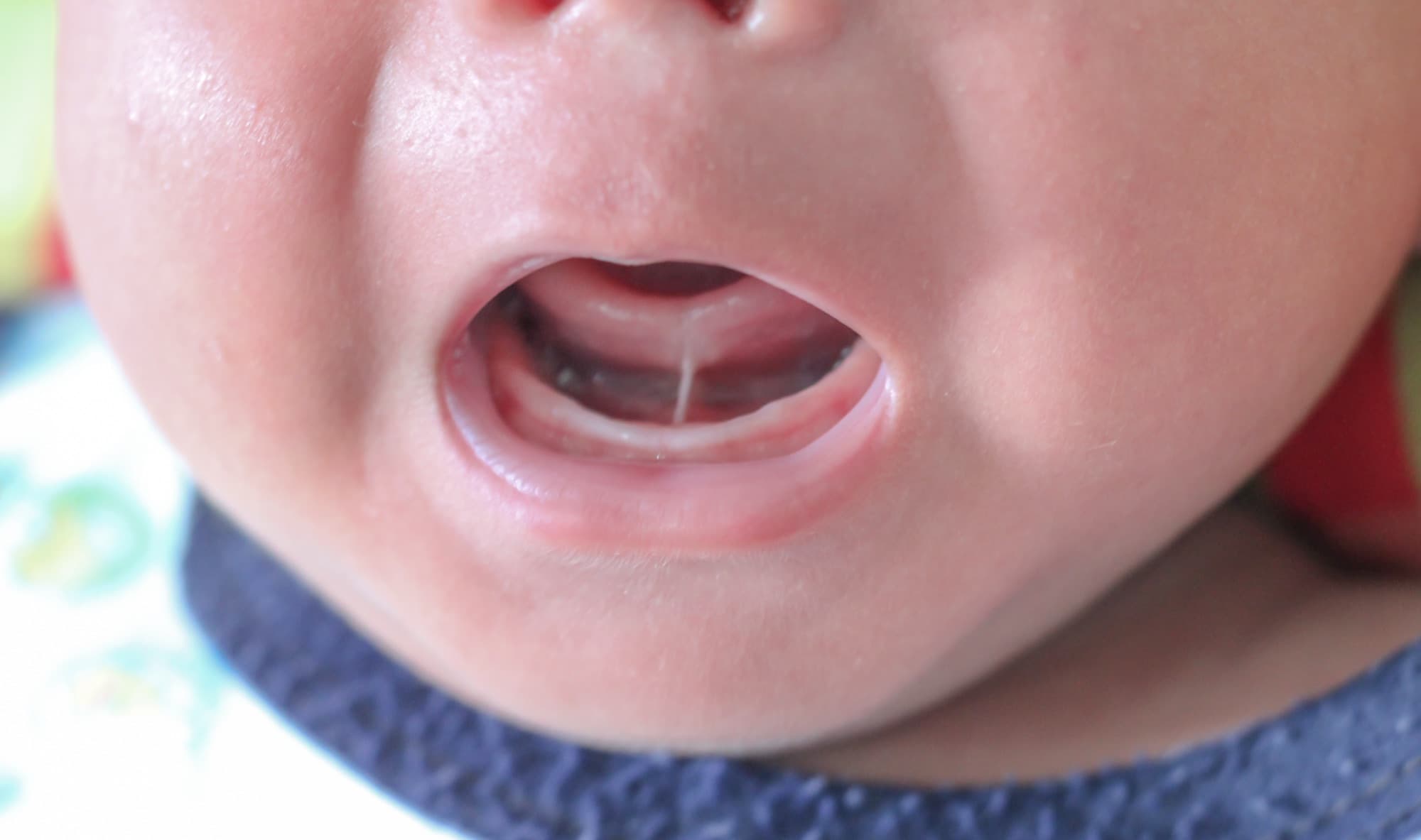 Bouche d'un nourrisson montrant un frein de langue court