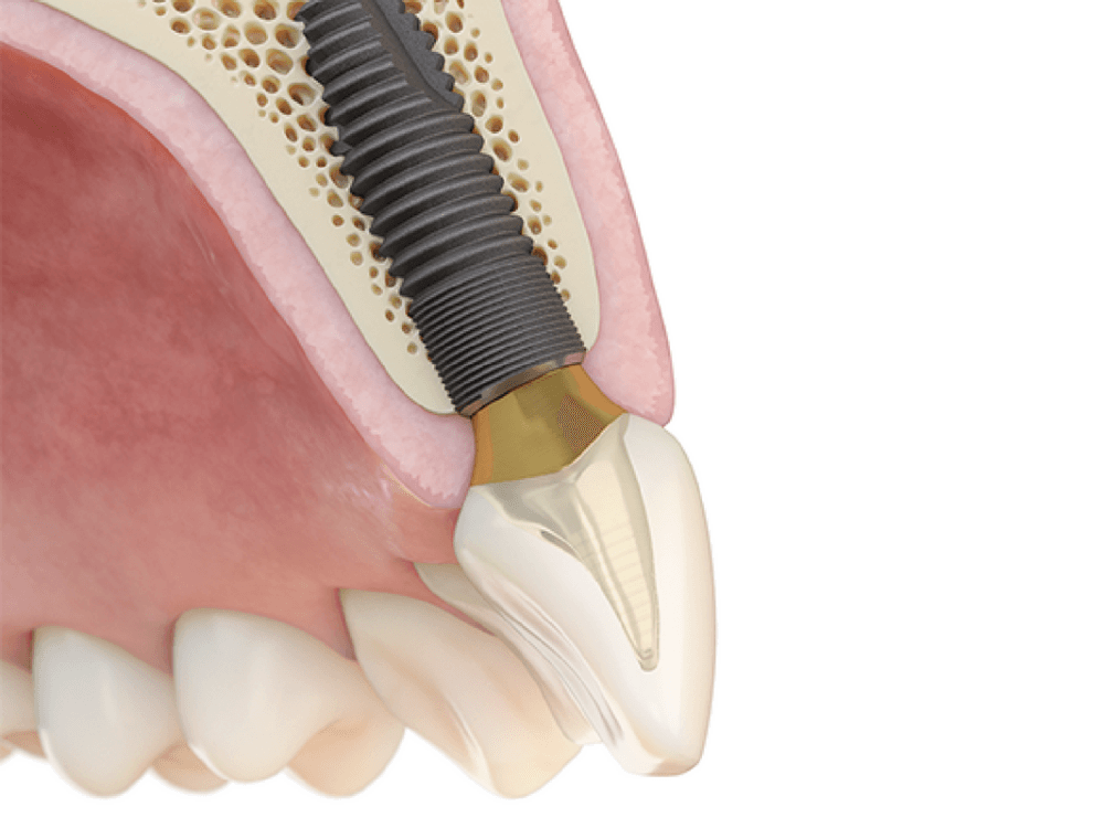 Vue en coupe d'un implant dentaire en titane intégré dans l'os, avec sa couronne