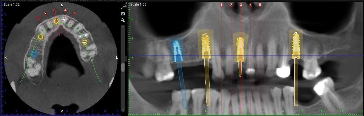 Planification implantaire 3D