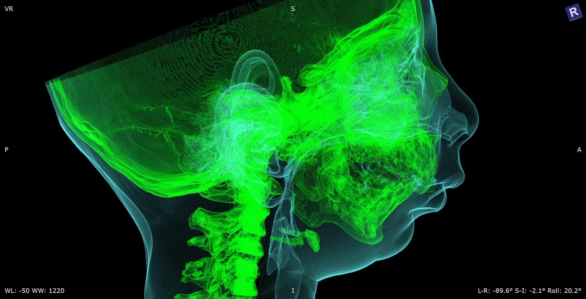 Reconstruction 3D d'un scanner crânio-facial